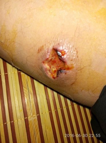 我爸大腿上长了个疖子,去医院医生用刀割了个十字口子,直径约20mm,急