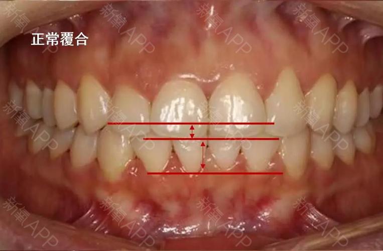深覆合 正常的牙齿咬合,是上前牙盖过下前牙的距离不超过下前牙