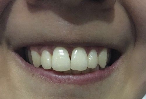 牙科:今年23岁,我的牙齿门牙中间有黑三角,牙龈萎缩了