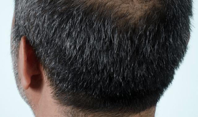 白发长在前额,两鬓,后脑勺,这意味着什么?_头发