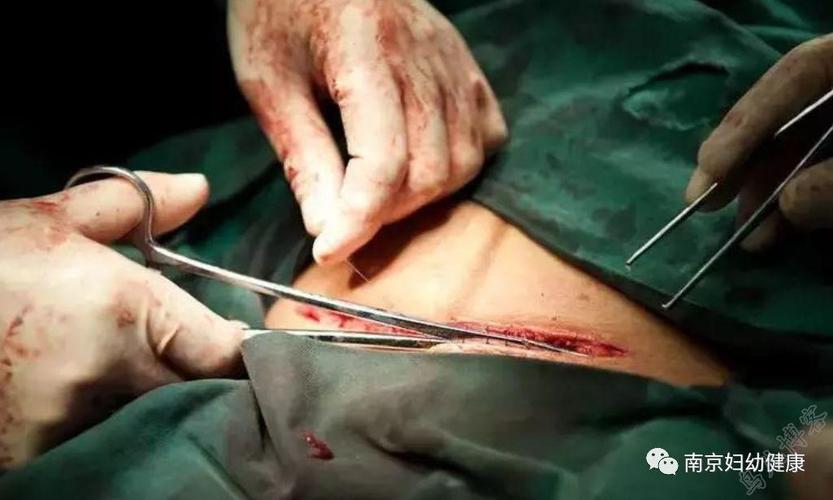 缝合好的伤口非常平整最后用纱布将伤口盖住避免感染到剖腹产的切口