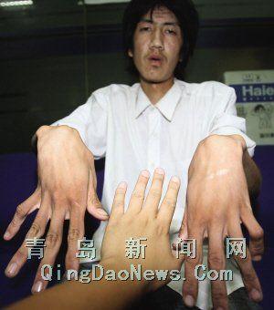 刘元患有马凡氏综合症,手指关节异常,又称蜘蛛指.