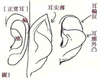 第4露:耳露 耳露就是反耳廓,就是轮廓整个外翻的,露的话里面的骨头跑