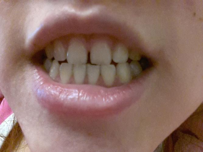 你好,医生,我的牙齿门牙有缝隙,如图,像这种情况要怎么办
