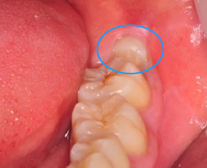 张嘴能看到下牙里面有颗长出一点的牙齿,这可能就是智齿