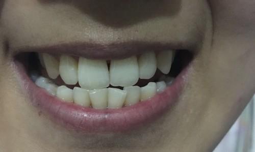 牙科:今年23岁,我的牙齿门牙中间有黑三角,牙龈萎缩了
