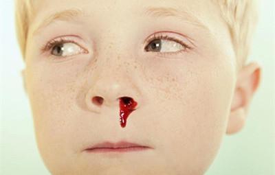 所以当自己的孩子出现了流鼻血以后,就特别担心,担心自己的孩子流鼻血