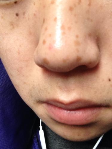 男生鼻子上有雀斑怎么有效去除?不要无依据的方法!