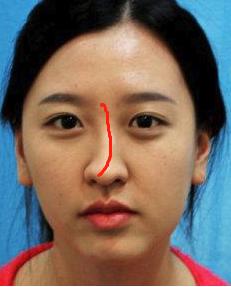 鼻梁歪斜每个人的脸都会有很小程度的不对称,鼻子也是一样,在面相学中